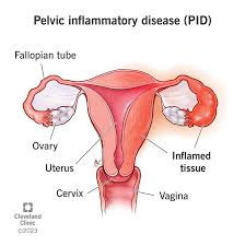 pelvic inflammatory disease treatment in Saudi Arabia