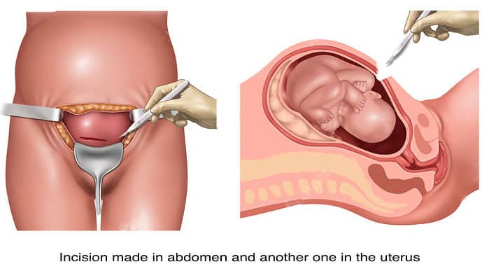 Cesarean Section in Saudi Arabia (C-Section) : Cost, Risks, Recovery & Complete Guide