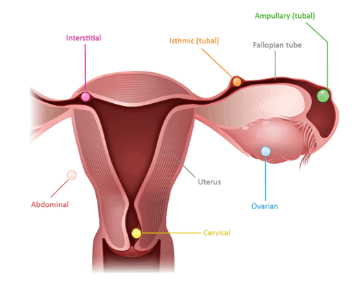Ultrasound showing ectopic pregnancy in a fallopian tube
